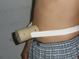 灸療導(dǎo)入器艾灸糖尿病