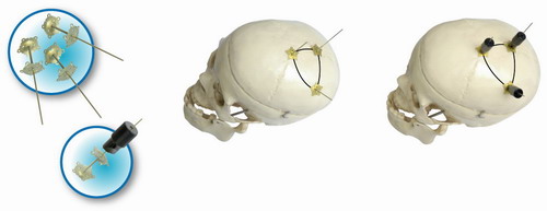 顱骨固定系統(tǒng)鈦合金顱骨鎖