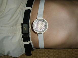 家用溫灸器腹痛腹瀉隔姜灸