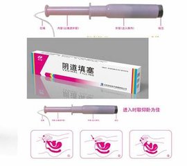 秦魯陰道填塞吸附栓OEM貼牌定制 代理代加工
